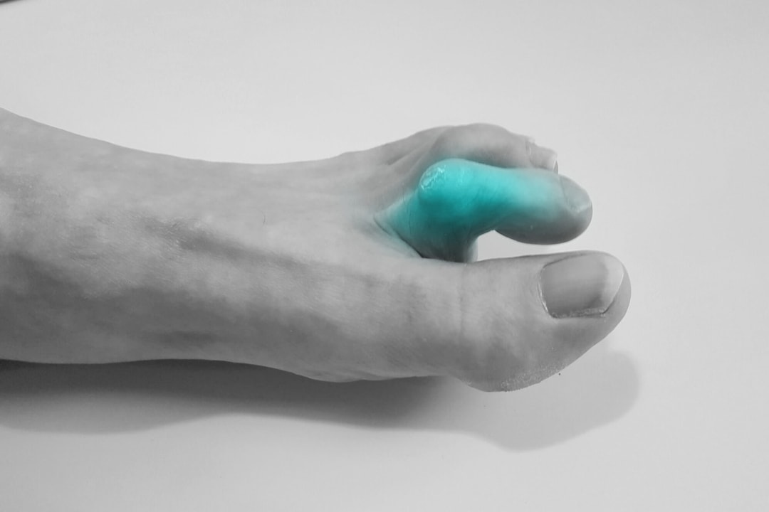 Claw Toe/Hammer Toe Mississauga Foot Clinic